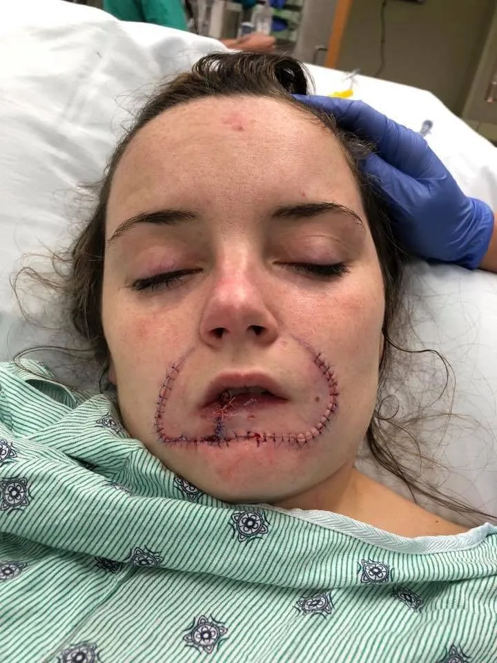 Mulher tem o lábio arrancado a mordidas pelo ex-namorado