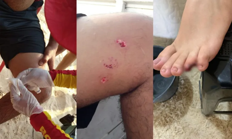 Mordidas, feridas e dedo amputado: série de ataques de peixes em praia paraense preocupa banhistas