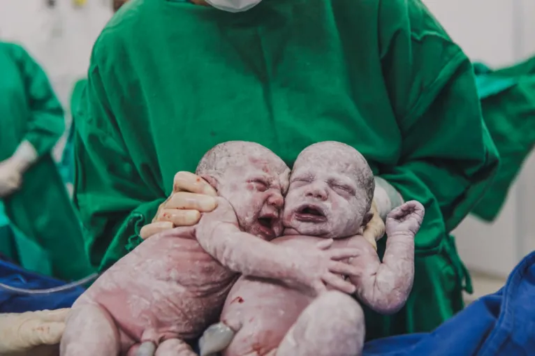 Gêmeas se abraçam após parto e fotos emocionam