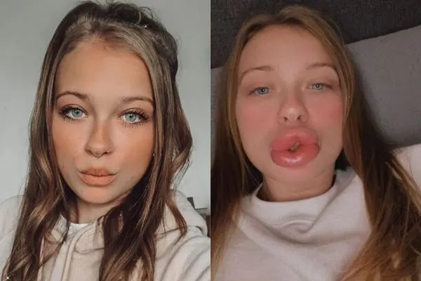 Louise antes e depois do procedimento nos lábios