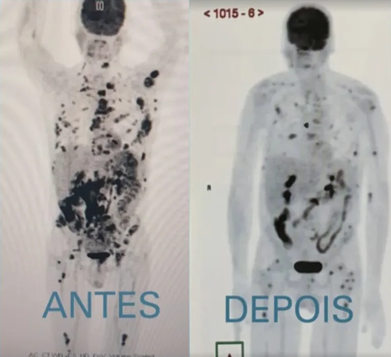 Comparação da tomografia do início (esquerda) e depois de meses infectados com Sars-Cov-2 (direita)