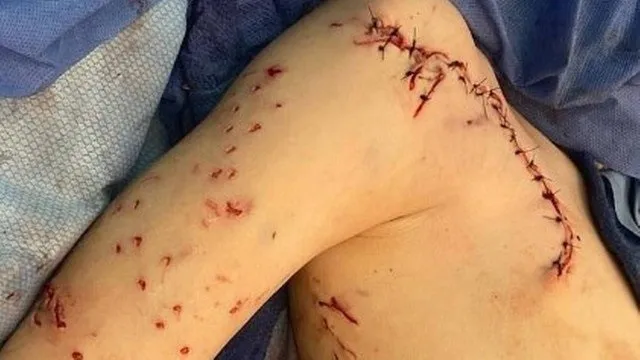 O menino levou mais de 20 pontos no tronco, do ombro até o peito, no lado direito