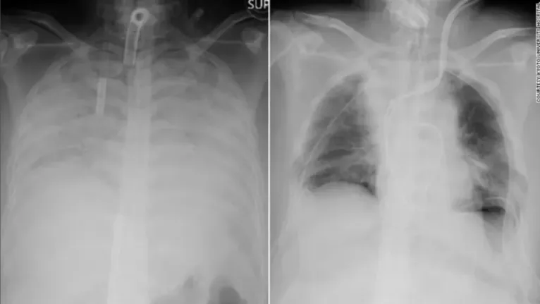 Radiografias mostram o tórax da paciente antes e depois do transplante