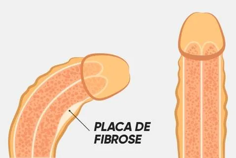 Já
ouviu falar na doença de Peyronie? ou do pênis torto?