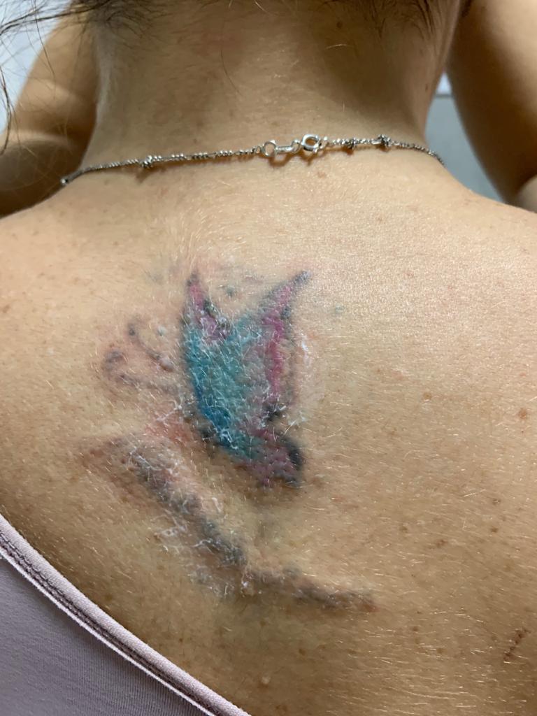 Tatuagem de Paula após 3 sessões de laser