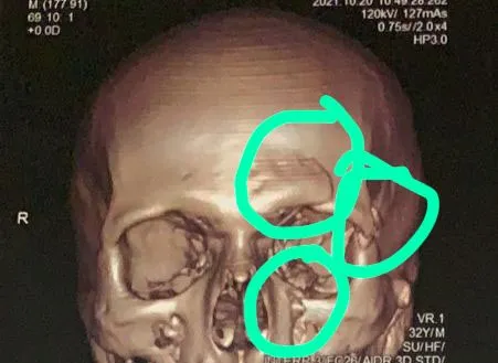 Resultado do exame que mostra as várias fraturas na face do zagueiro Bernardo, do União Paraense.