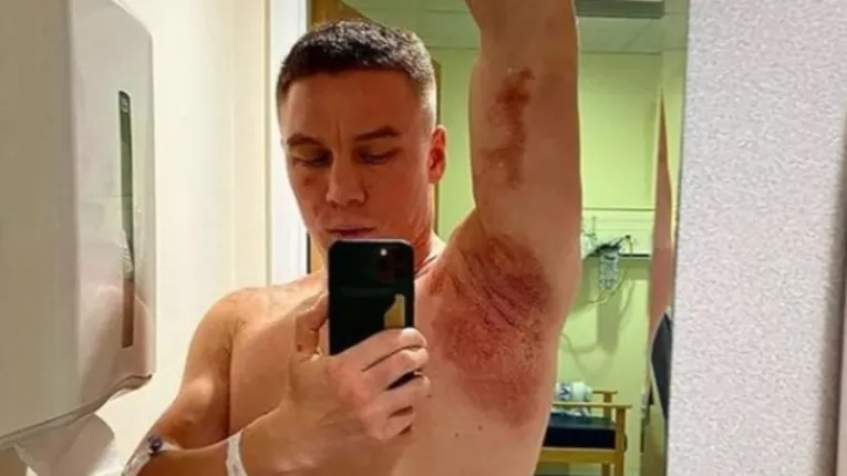 Campeão mundial de boxe é atacado com ácido por encapuzados