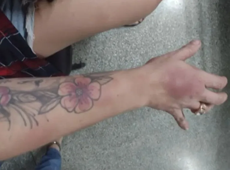 Vítima apresenta hematomas pelo corpo.