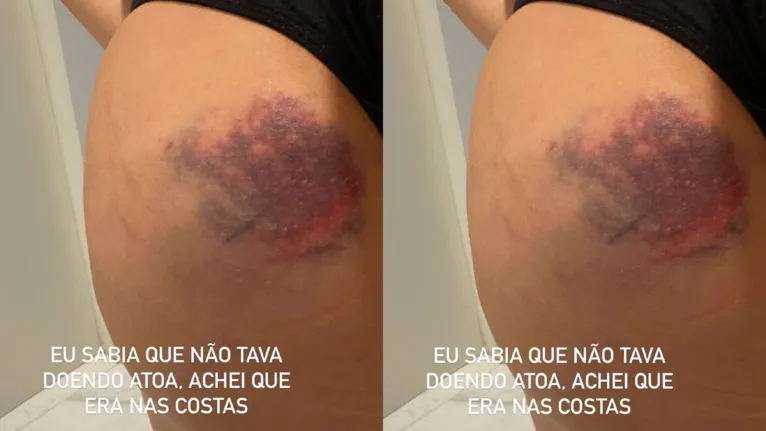 Veja o vídeo: Viih Tube mostra bumbum com hematoma imenso