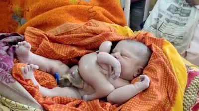 Deus? Bebê nasce com 4 braços e 4 pernas, veja o vídeo!