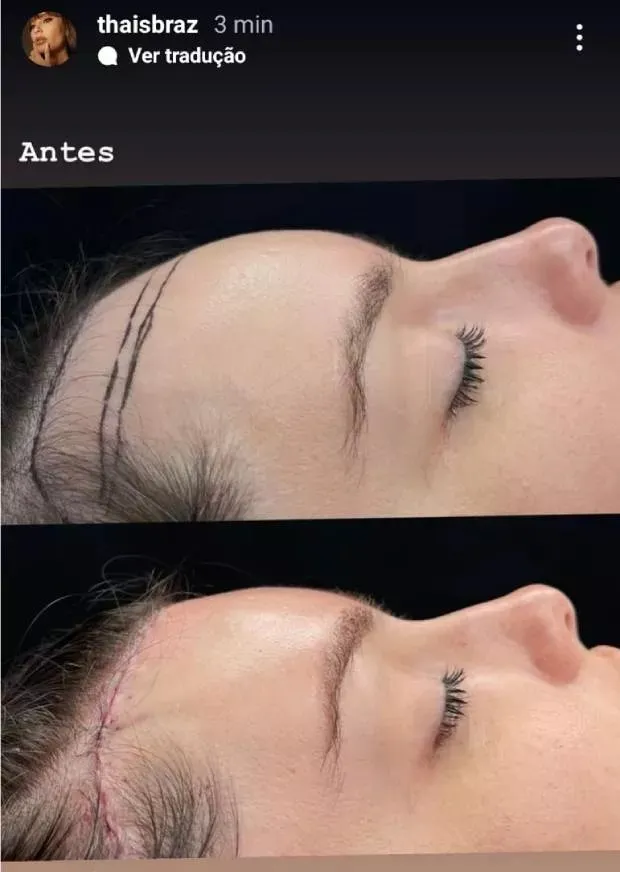 Antes e Depois