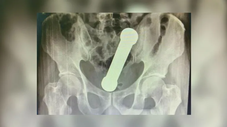 O haltere foi identificado após um raio-x