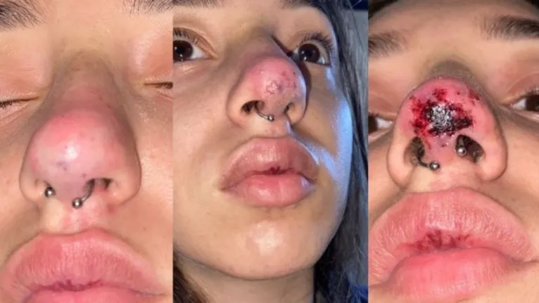 O nariz da jovem ficou necrosado após o procedimento.