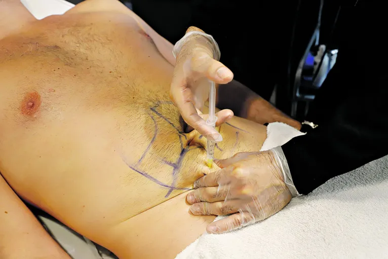 Belém, Pará, Brasil. Procedimentos estéticos masculinos. Daniel Sales, esteticista e biomédico, realizando procedimento estético (Ozonioterapia) no paciente Raul Moreira. 02/02/2022. Foto: Octavio Cardoso / Diário do Pará