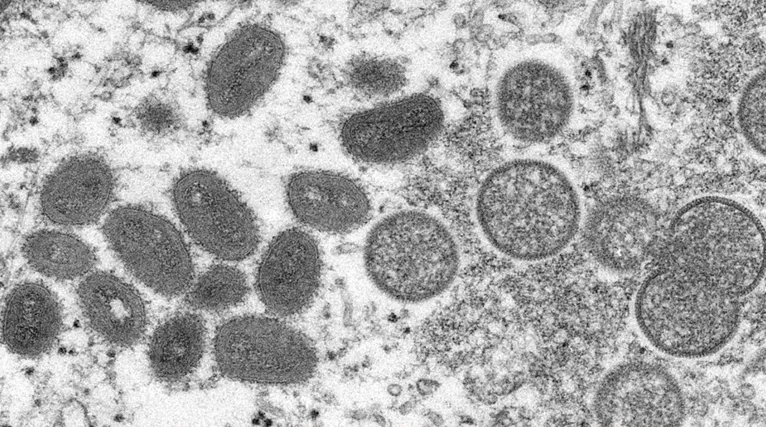 A varíola dos macacos é uma doença viral rara transmitida pelo contato próximo com uma pessoa infectada e com lesões de pele
