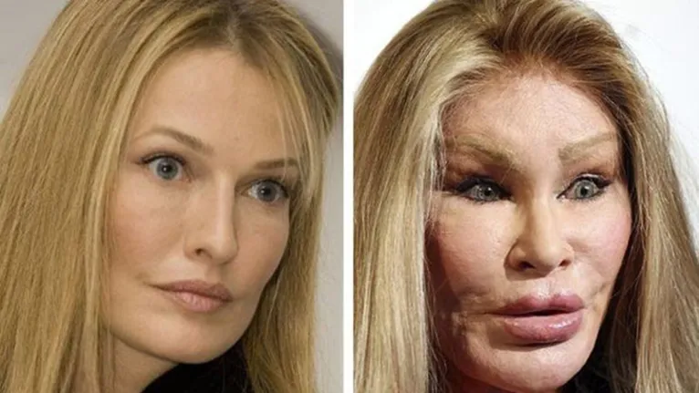 Estas 8 celebridades arrependeram-se de fazer cirurgias plásticas. Veja o  antes e depois e perceba porquê - Celebridades - MAGG