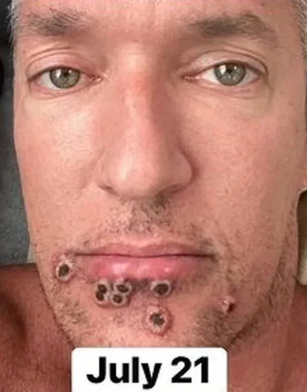 Com varíola, ator pornô mostra evolução das feridas no rosto