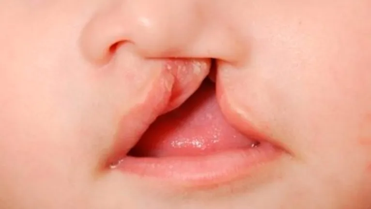 A OMS aponta que fenda palatina e lábio leporino são as mais frequentes anomalias congênitas, atingindo cerca de 10 em cada 10 mil crianças nascidas no mundo