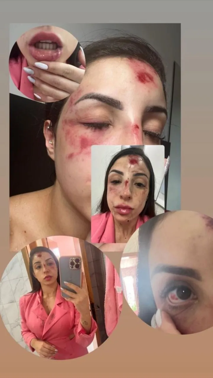 Influencer é agredida pelo namorado após querer término