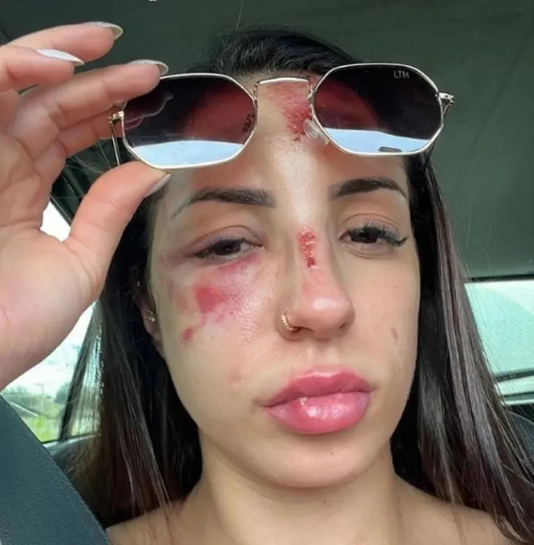 Influencer é agredida pelo namorado após querer término