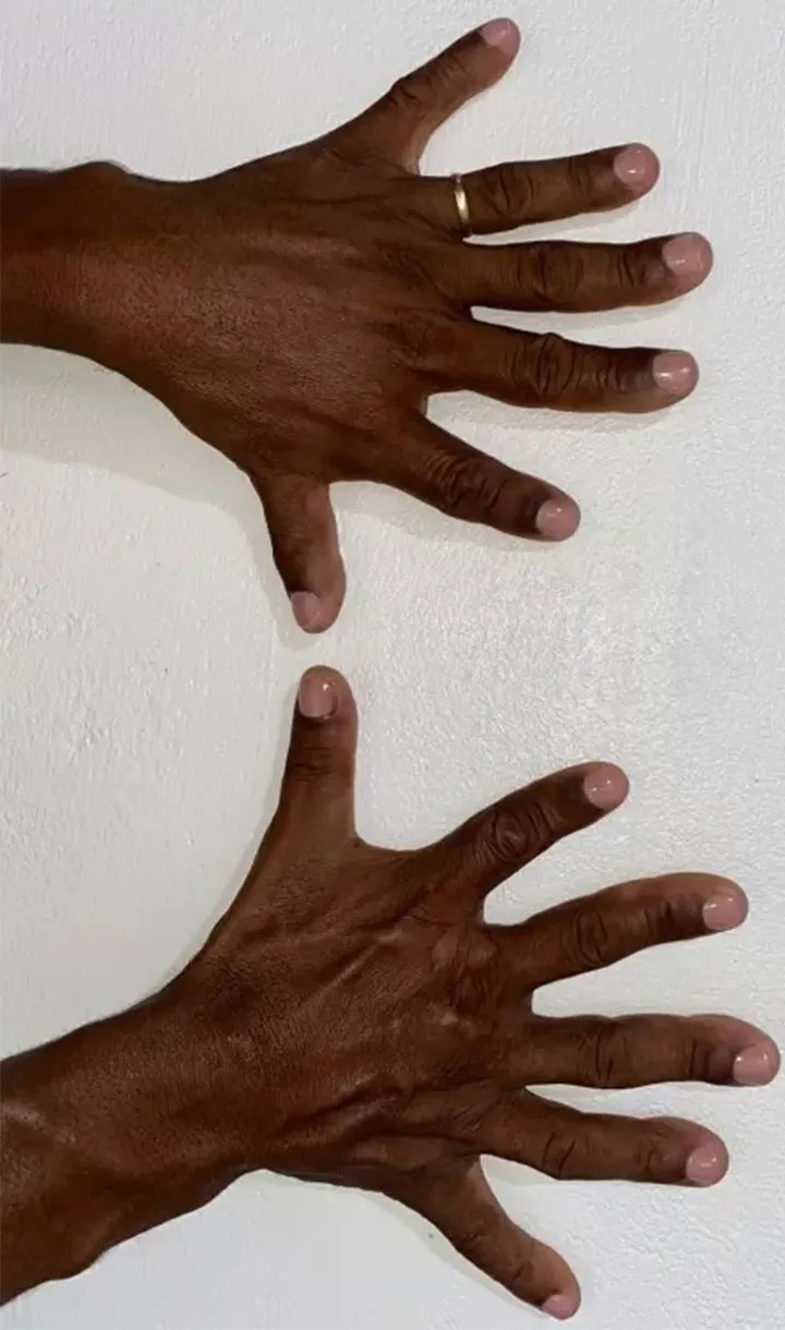 Josevaldo nasceu com seis dedos em cada mão