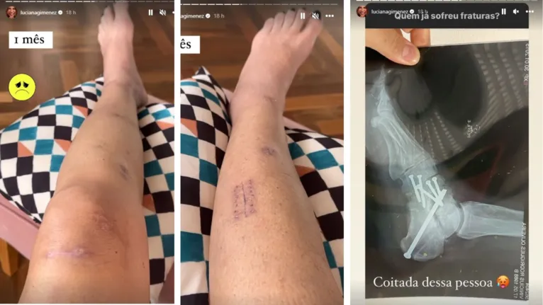 Luciana Gimenez mostra cicatrizes após acidente na neve