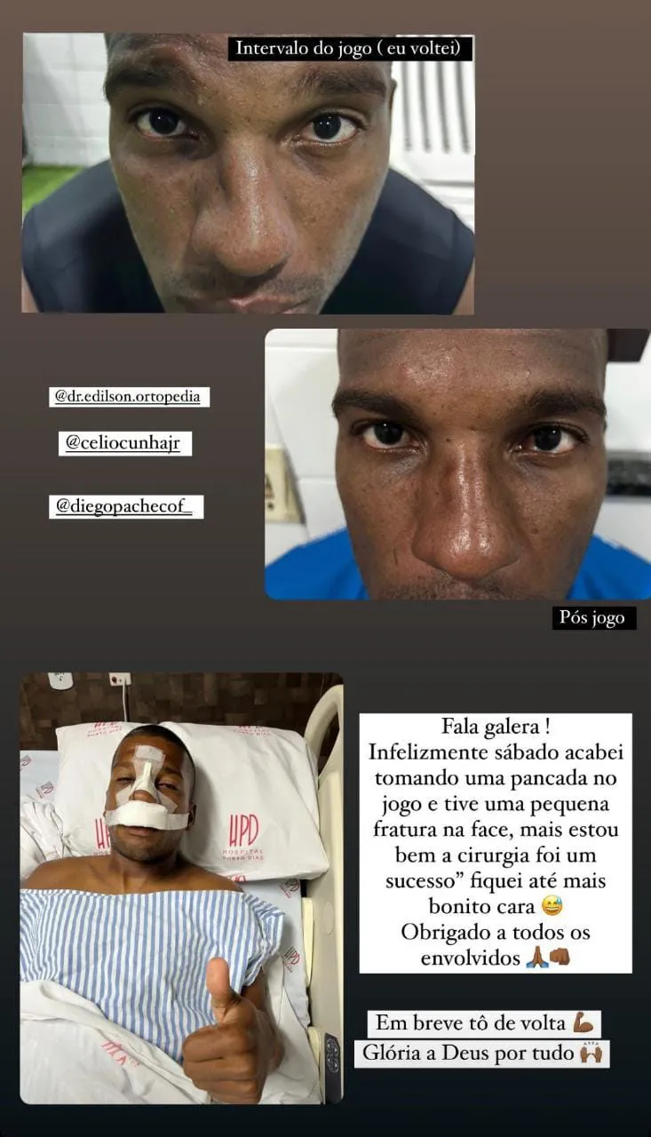 Capitão passa por cirurgia no nariz e desfalca o Paysandu