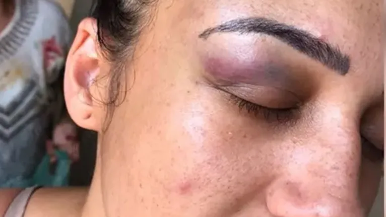 Beatriz foi agredida pelo irmão da mulher que tentou afogar seu filho na piscina em Bauru