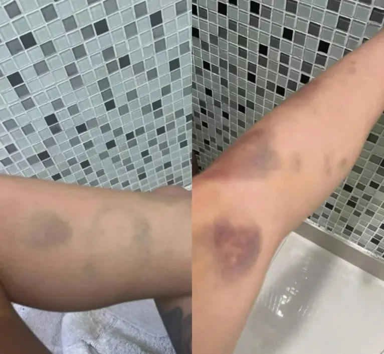 Tati Zaqui divulgou fotos do corpo com hematomas