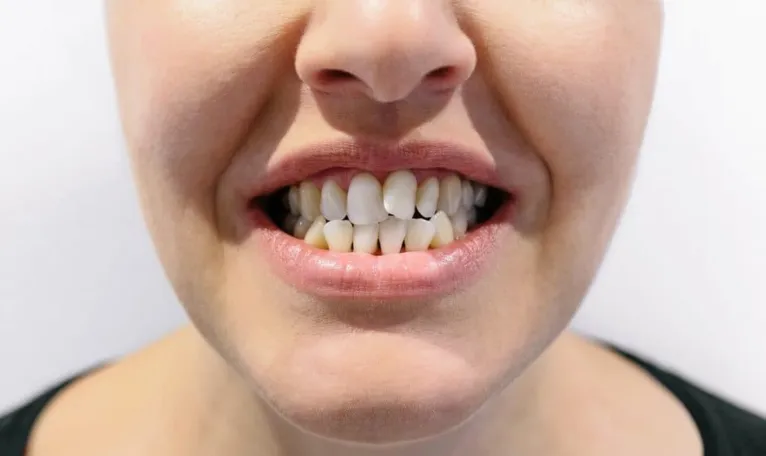 A má oclusão, como os dentistas chamam os dentes tortos, é um problema da sociedade moderna.