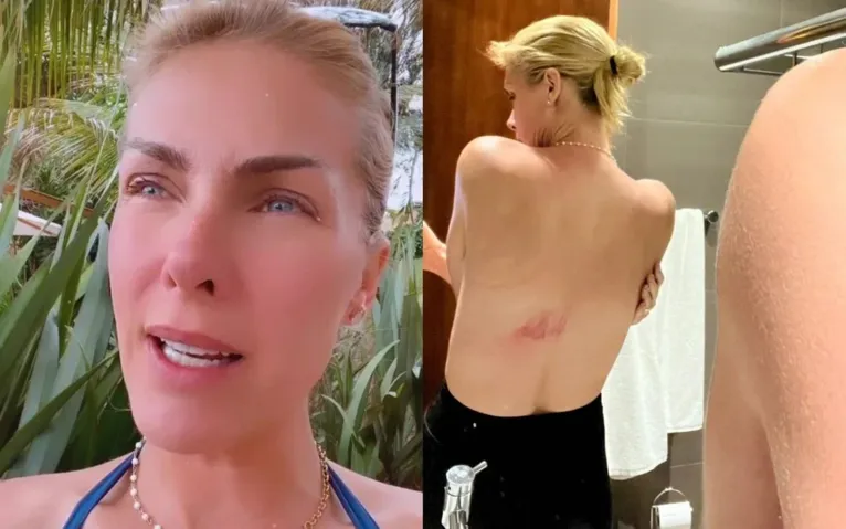 Ana Hickmann mostra machucado após cair do cavalo