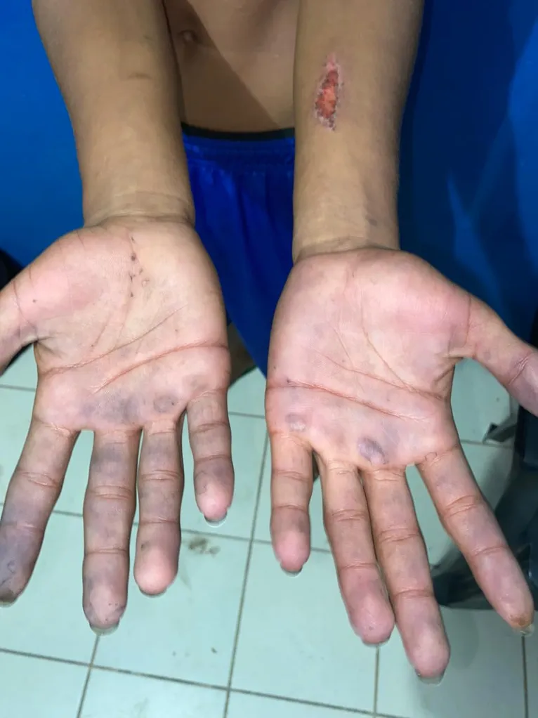 Mãos do adolescente após a tortura