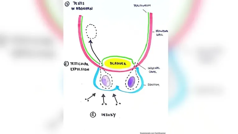 Um diagrama desenhado pelos autores do estudo mostrando como o testículo direito do homem foi forçado contra seu abdômen