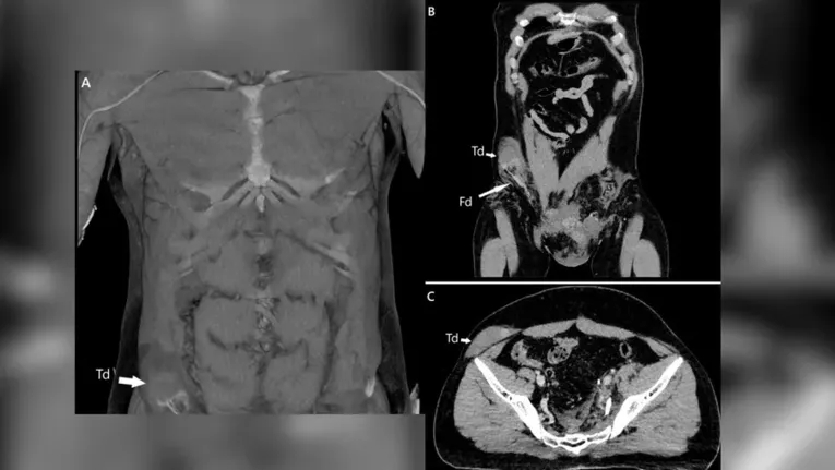 Testículo direito do paciente, denotado como 'Td' nas imagens acima, se deslocou para o abdômen