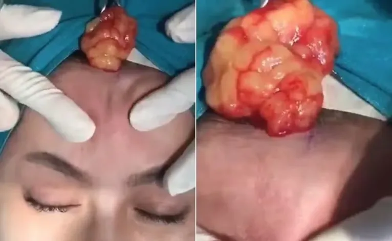 O cirurgião da clínica fez um corte e espremeu lentamente a massa