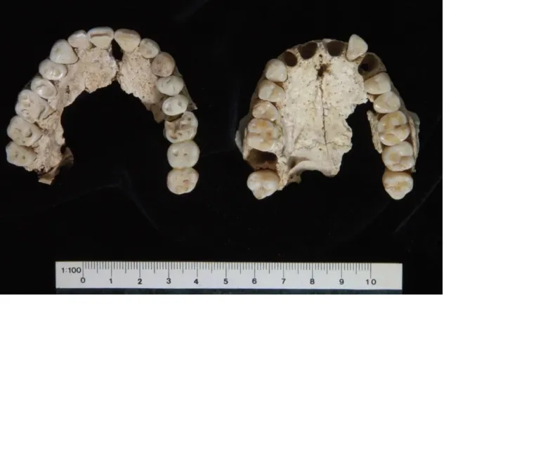 Duas maxilas encontradas na Tumba I em Vergina. O da esquerda é um homem adulto robusto de meia-idade e o da direita é uma mulher adulta jovem.