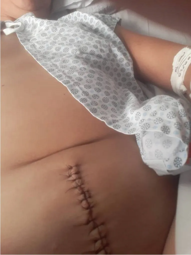 A dona de casa Andréia Rodrigues do Nascimento, 42, mostra a barriga após a cirurgia para retirada do DIU