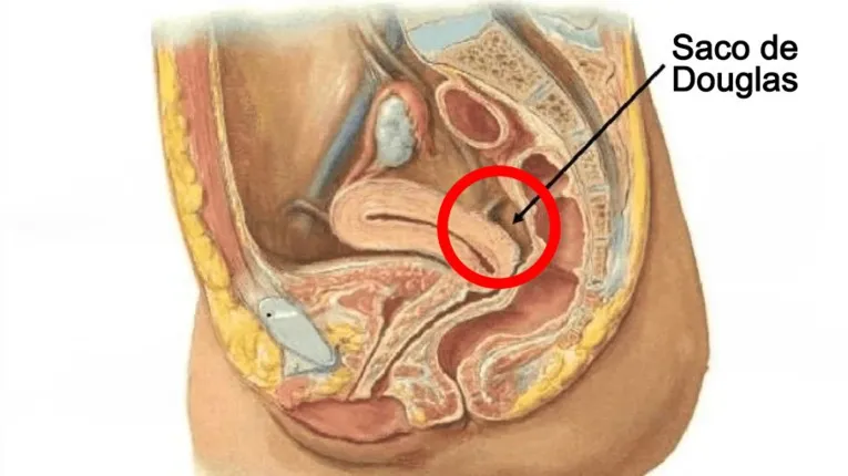 Nas mulheres, o espaço está localizado entre o útero e o reto. Nos homens, a estrutura fica entre o reto e a bexiga