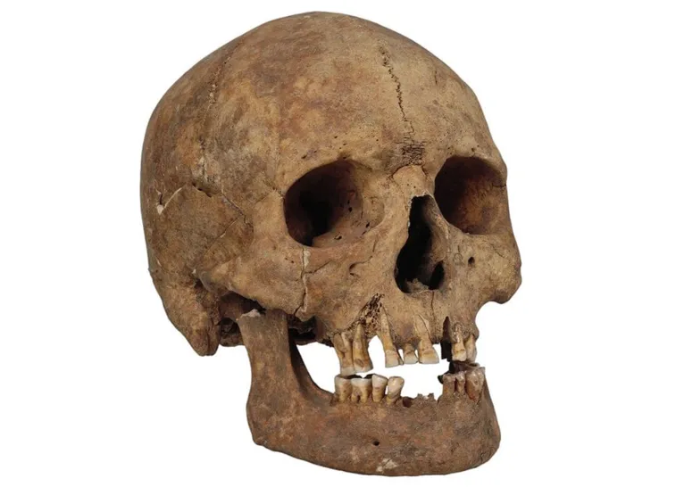 Crânio de um homem com dentes limados que foi enterrado em Gotland durante a Era Viking.