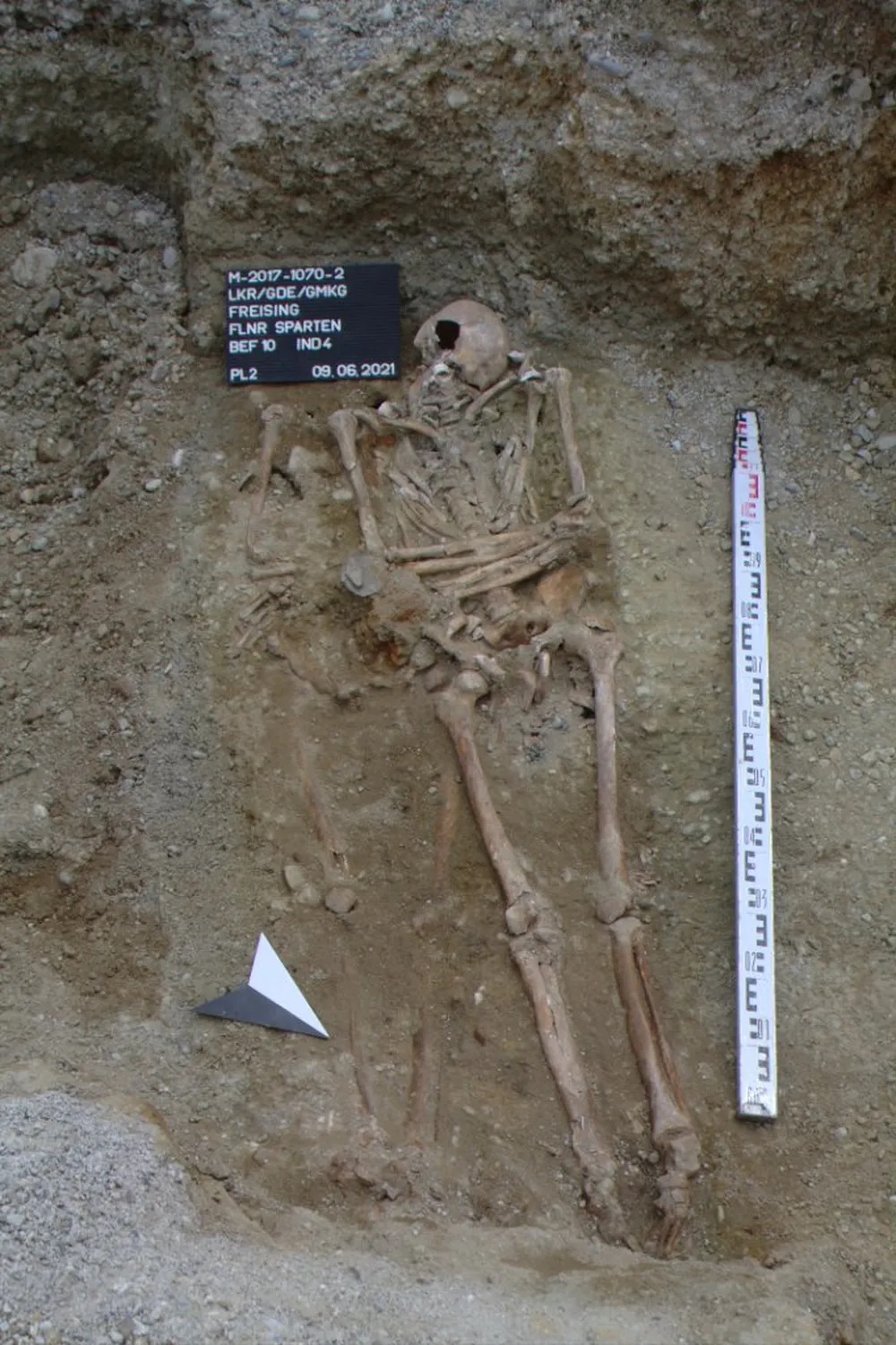Esqueleto de homem medieval com prótese de mão