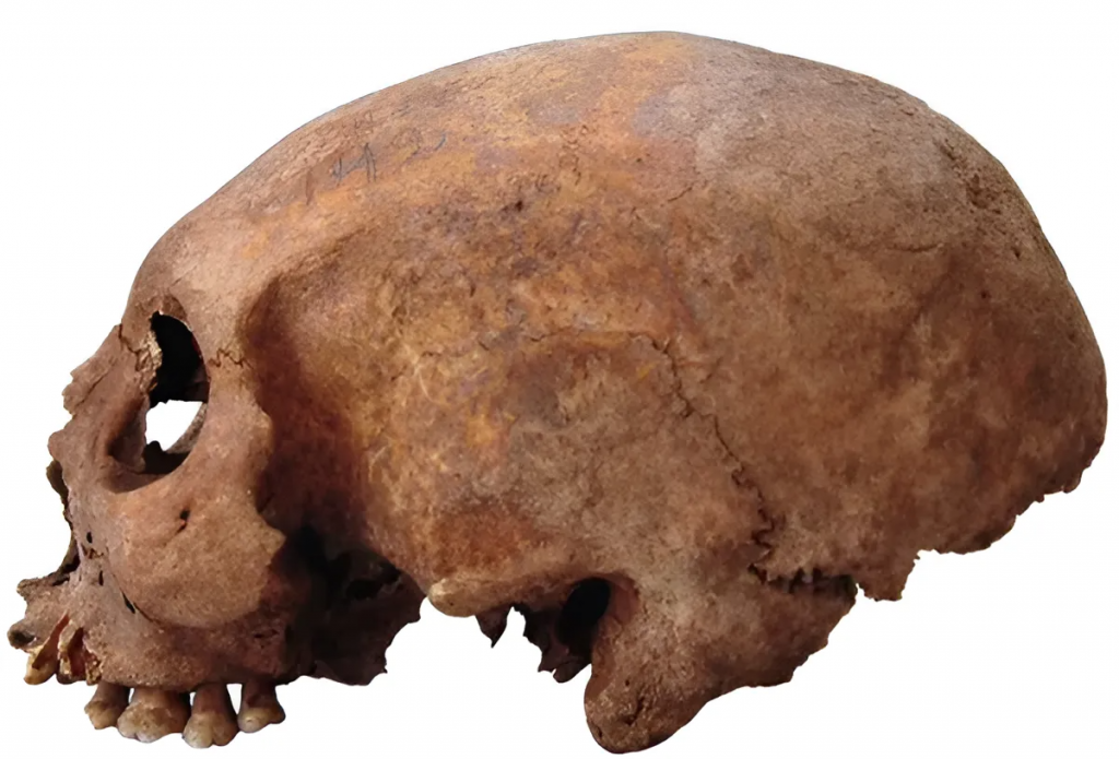 Um dos crânios alongados de uma mulher enterrada no século 11 na ilha báltica de Gotland.