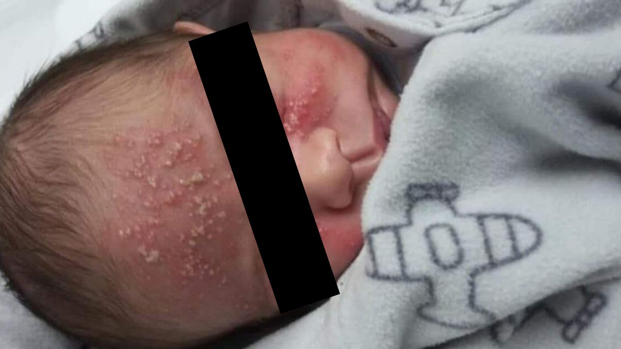 Bebê contrai herpes após beijo de visita