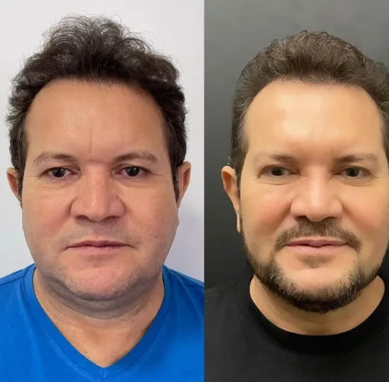 Antes e depois de Ximbinha.