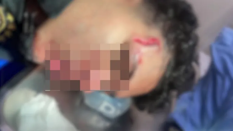 Adolescente ficou com ferimentos graves no rosto após ataque de cão em Paragominas
