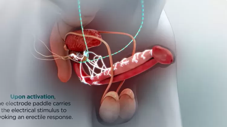 Esquema mostra funcionamento do dispositivo na genitália masculina.