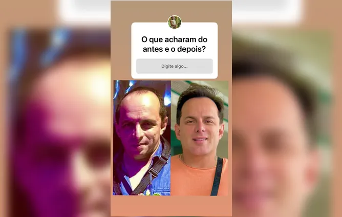 Esdras de Souza mostrou o antes e depois de seu rosto nas redes sociais