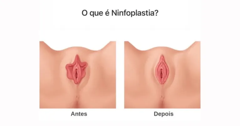 Mãe de Vanessa Lopes faz cirurgia íntima: "Não me arrependo"