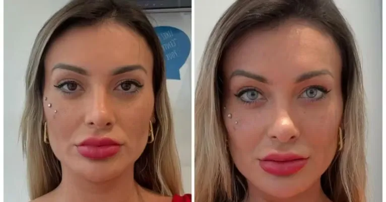 Andressa Urach se arrepende de cirurgia para clarear olhos: 'Muita dor'