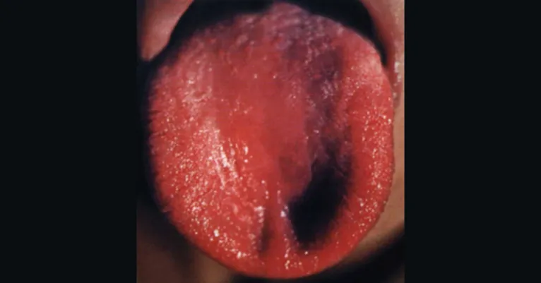 Língua avermelhada