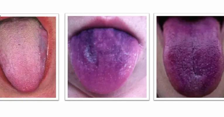 Coloração violeta ou azulada